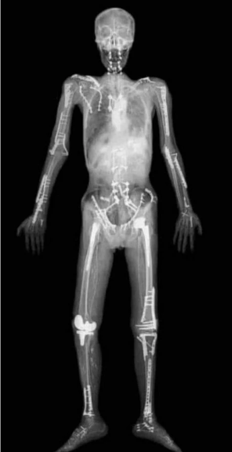 orthopedic accident trauma main dr vaibhav shirke best orthopedic trauma surgeon fractures pune